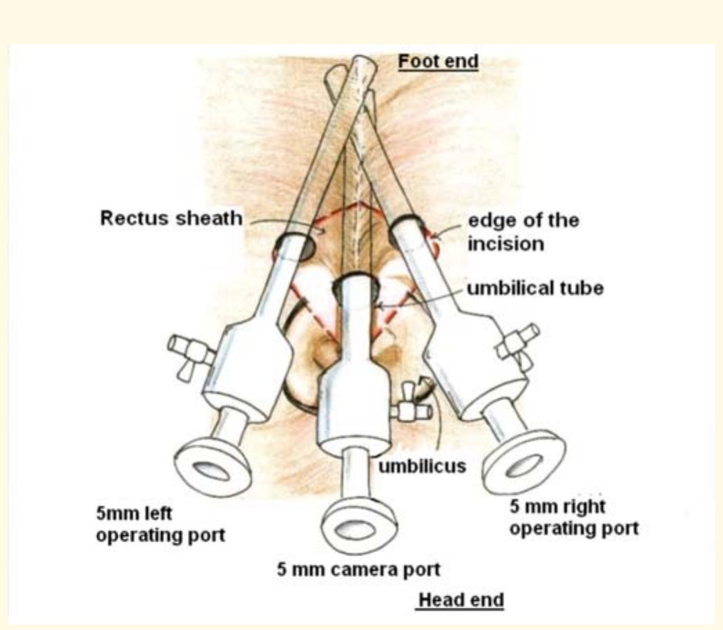 Port Position Schematic representation of port position for sils