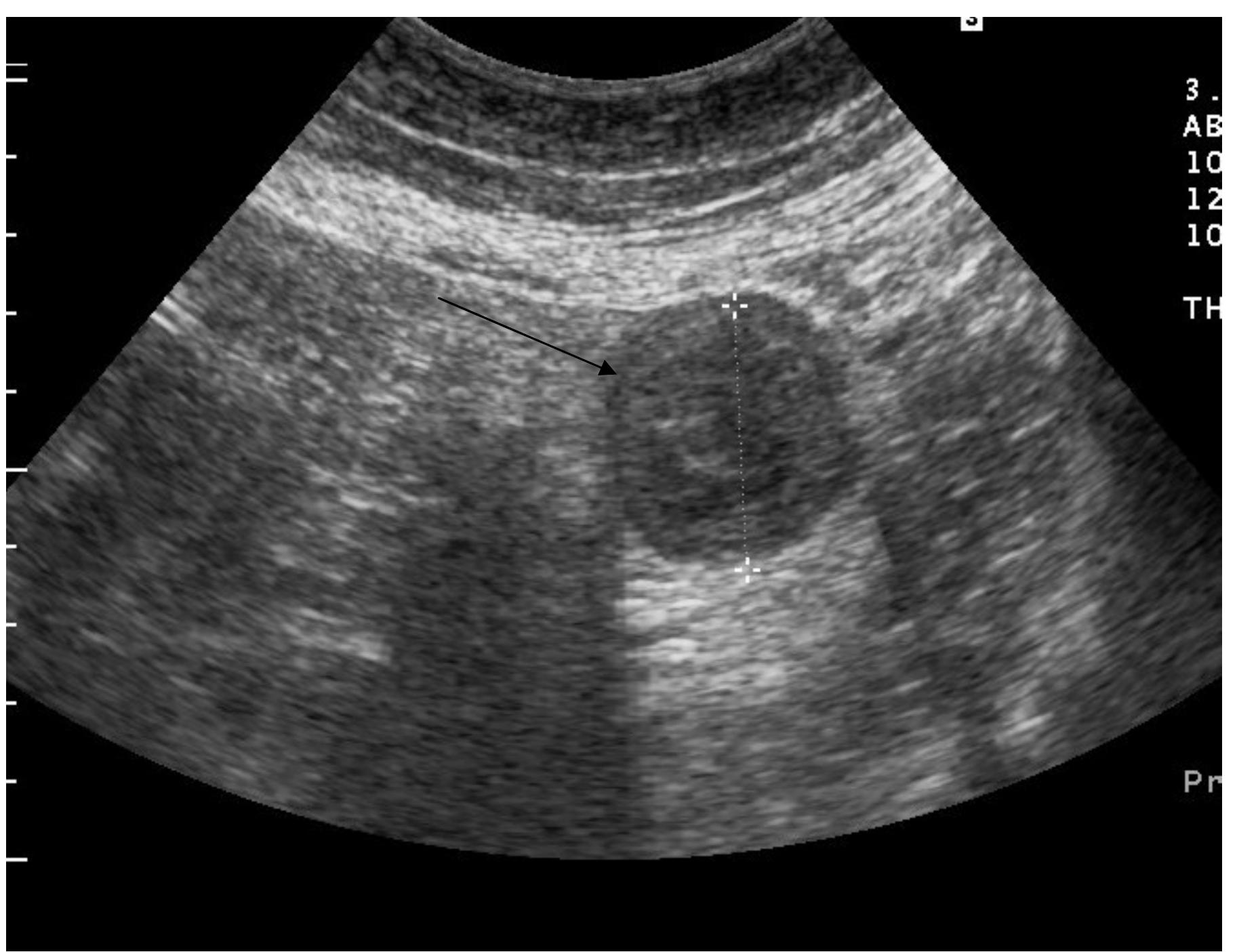 (PDF) Colonoscopic Diagnosis and Treatment of Periappendicular Abcsess