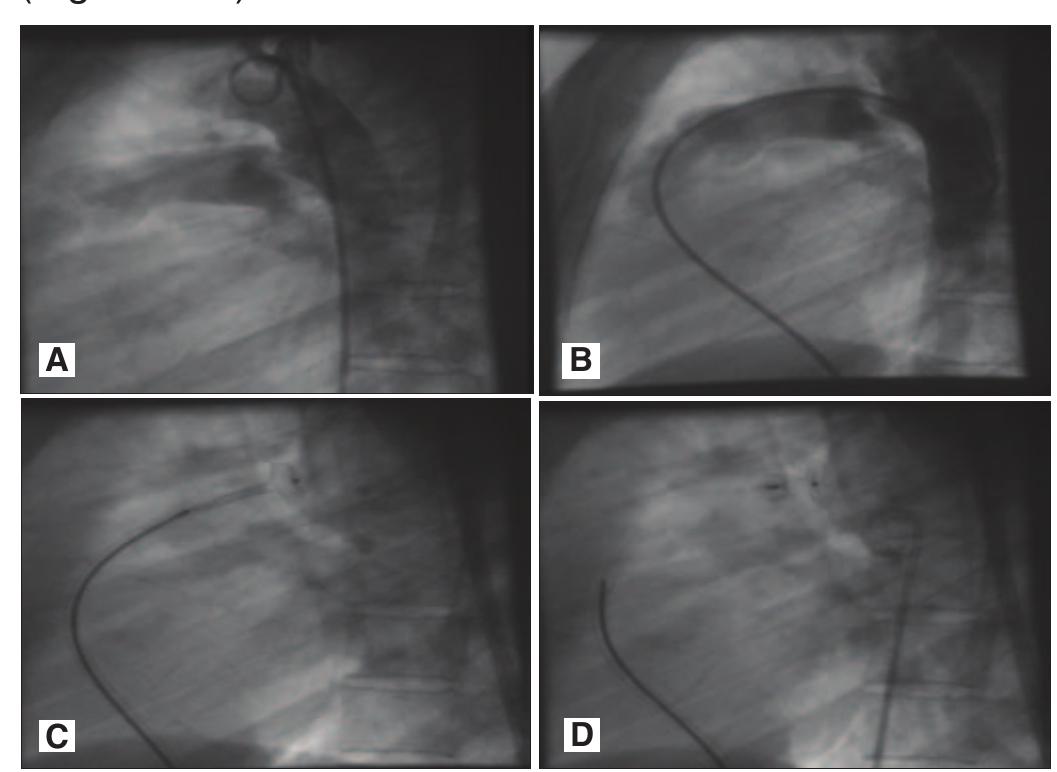(PDF) Transcatheter closure of large sized patent ductus arteriosus ...