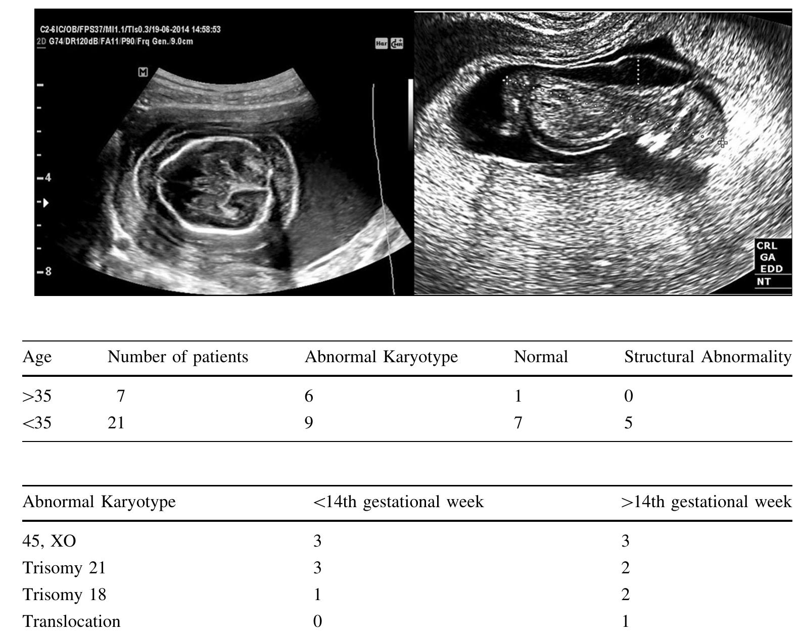 and one case of translocation were seen in fetuses within the late onset CH group.  All observed structural abnormalities were also evalu- ated. There were five congenita  fetuses, and  17.8%. Specifically, prenatal abnormalities in the fetuses were nuchal teratoma in one,  ske of  letal dys Fallot) in one, congenital dia  fetal abnormalities in 28  the structural anomaly rate was found to be  y diagnosed - structural  plasia in one, congenital heart defect (tetralogy  phragmatic hernia concur-  rent with dextrocardia in one, and multiple anomaly (..e., hydrocephalus, single umbilical  cle ges  ft lip) in one. Hydrops feta tational week in the fetus wit  artery, rocker bottom foot, is developed at the 20th h nuchal teratoma, and the  pregnancy was ultimately terminated following counseling  wit  h the parents. The remaining  eight fetuses without any  coexisting problems (chromosomal abnormalities and/or congenital malformations) were delivered without any perinatal complications. CH was regressed before the 20th gestational week in these eight cases. 
