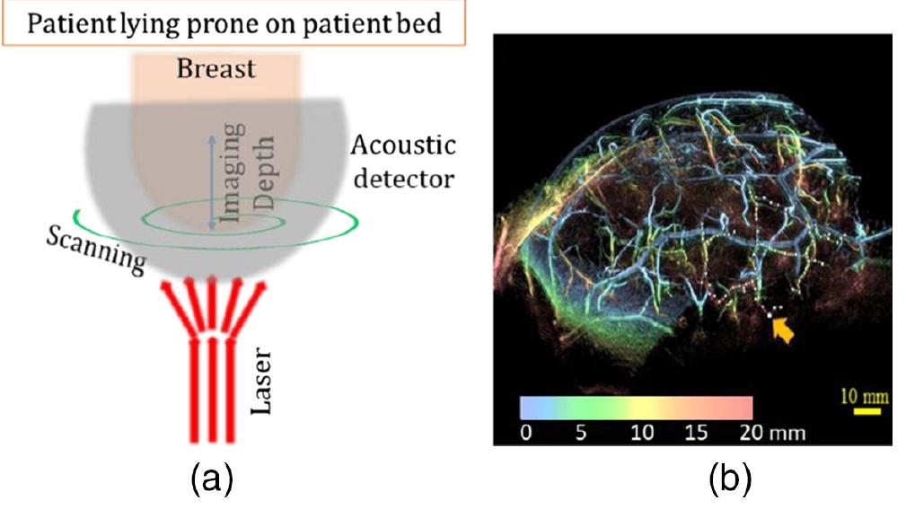 Figure 4 - from Photoacoustic imaging of breast cancer: a