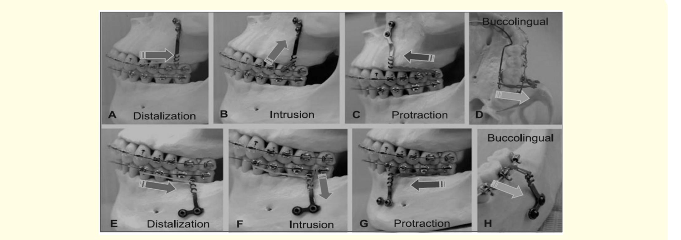 Miniplate position and biomechanics [4]. sures are to be