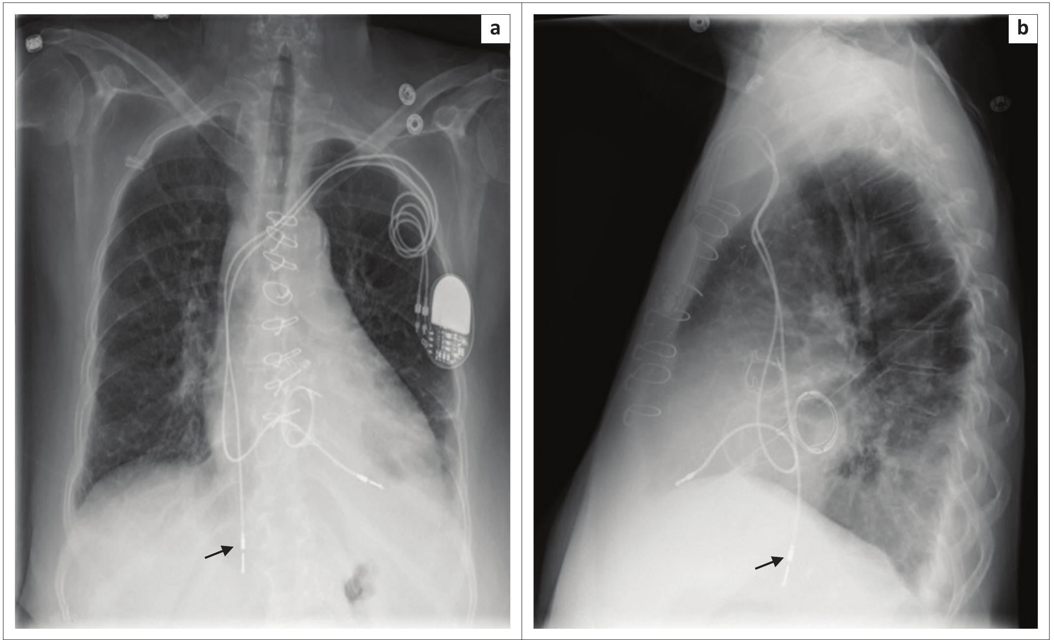 (PDF) Chest radiographs of cardiac devices (Part 2): Cardiovascular ...