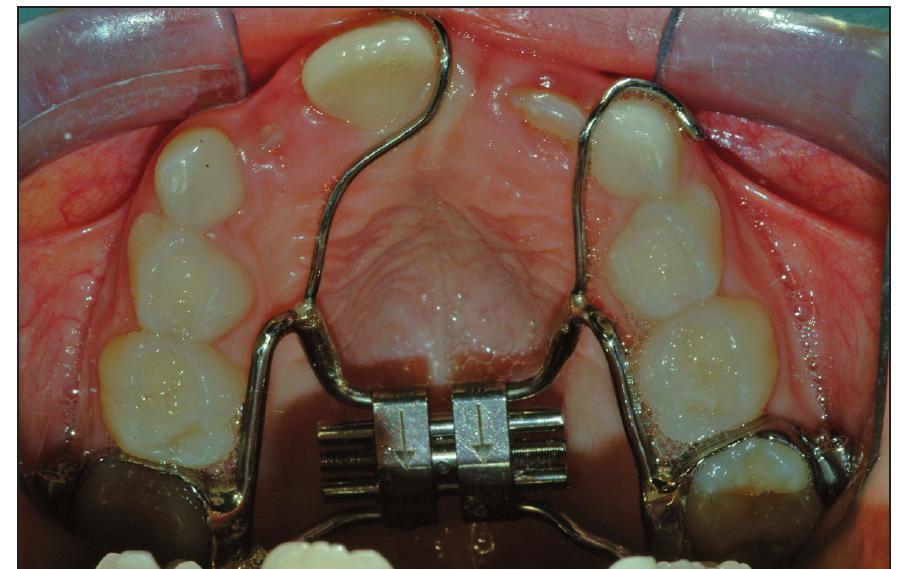 Expander Modify Figure 8 - from Impacted maxillary incisors: diagnosis and
