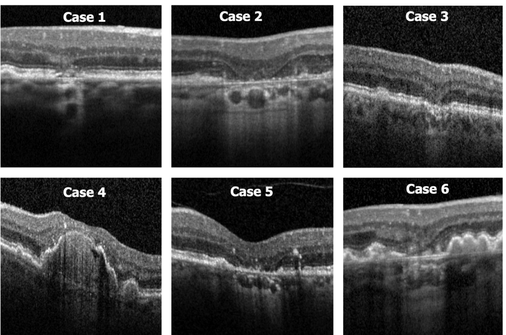 Montage of the oct images for the 6 patients shown in figure