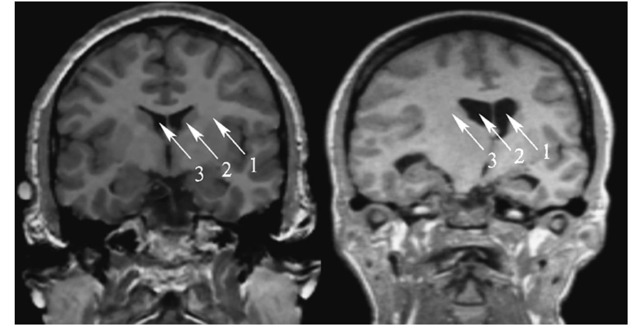 Figure 10 - from Atlas-Based Segmentation of Pathological MR
