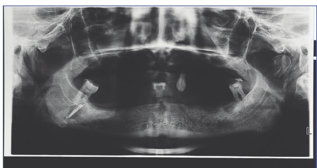 /fig-2]: panoramic radiograph showing fracture line