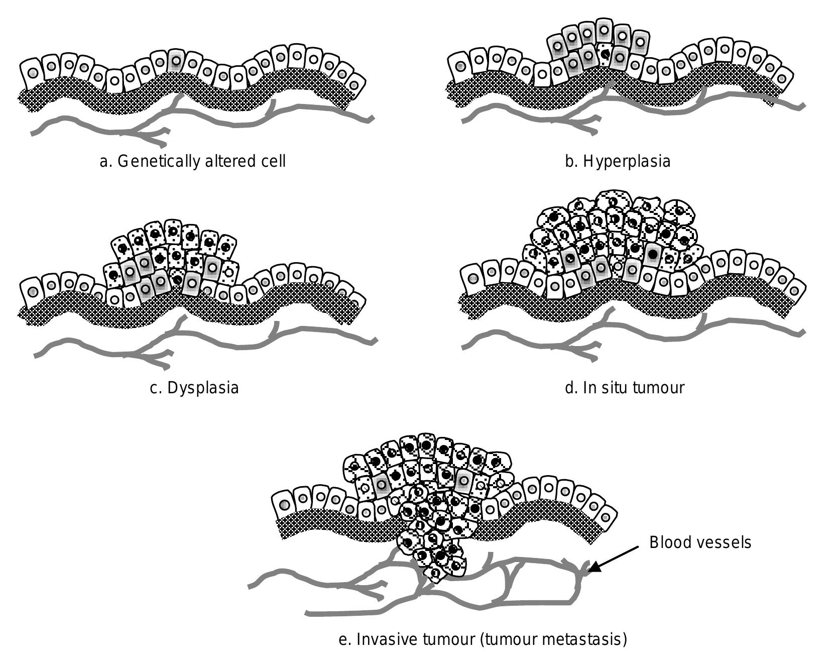 Mechanisms and stages of tumor development