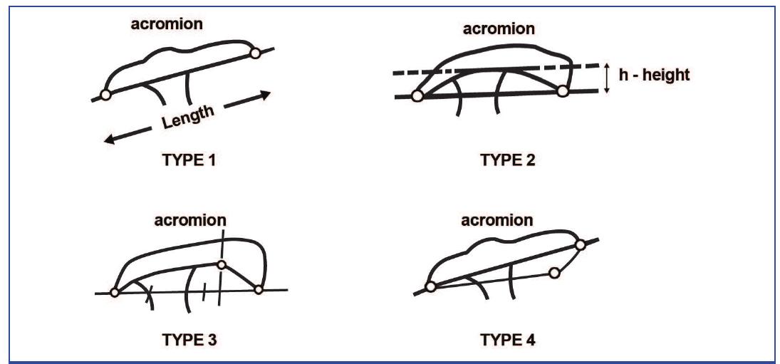 (PDF) Shoulder Impingement and its Association with Acromial Morphology ...