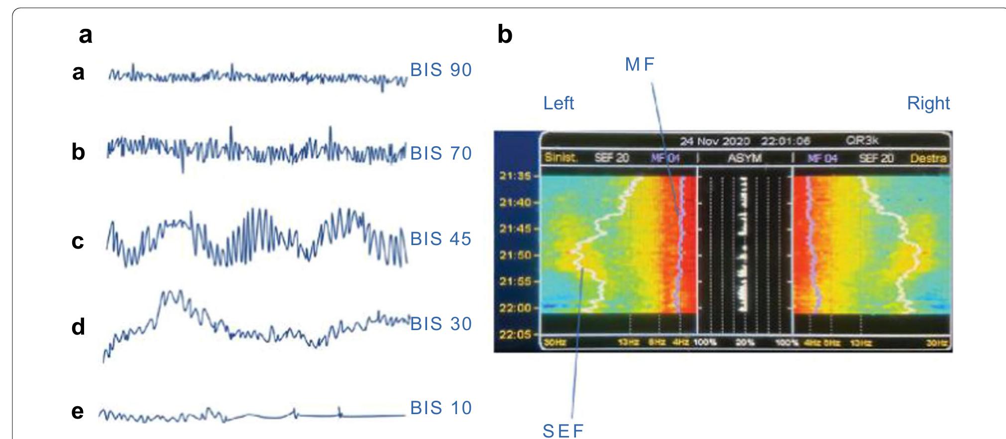 (PDF) The Importance of Neuromonitoring in Non Brain Injured Patients