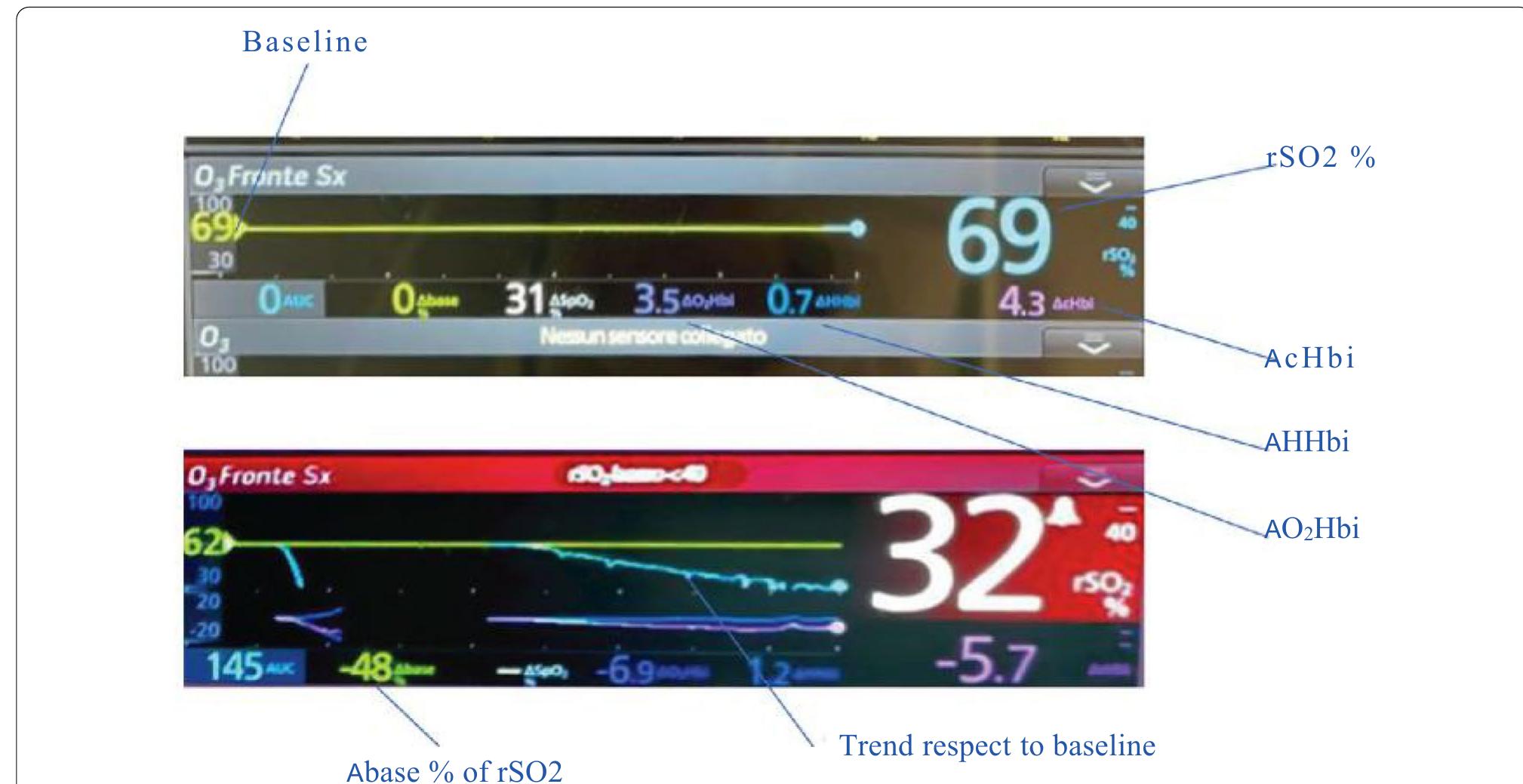 (PDF) The Importance of Neuromonitoring in Non Brain Injured Patients