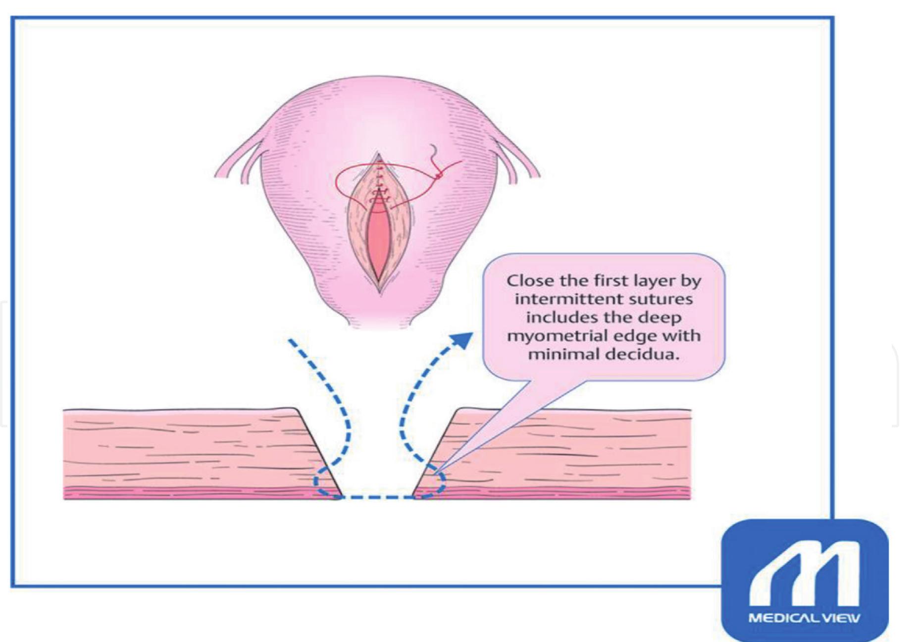 Operation First Incision I, © different types of uterine incisions. figure 6. go