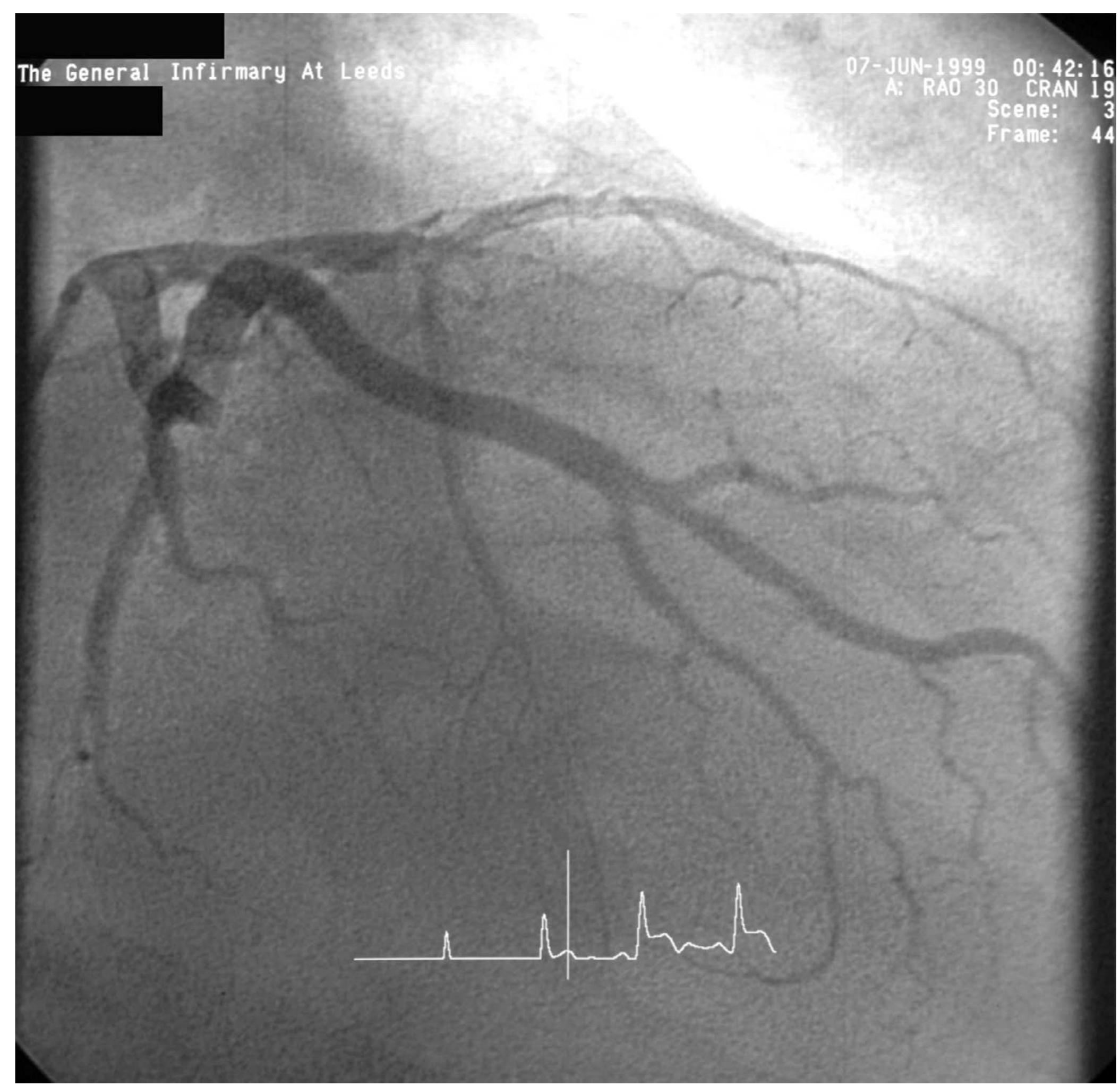 Figure 3 - from ssBioMed CentJournal of Cardiothoracic