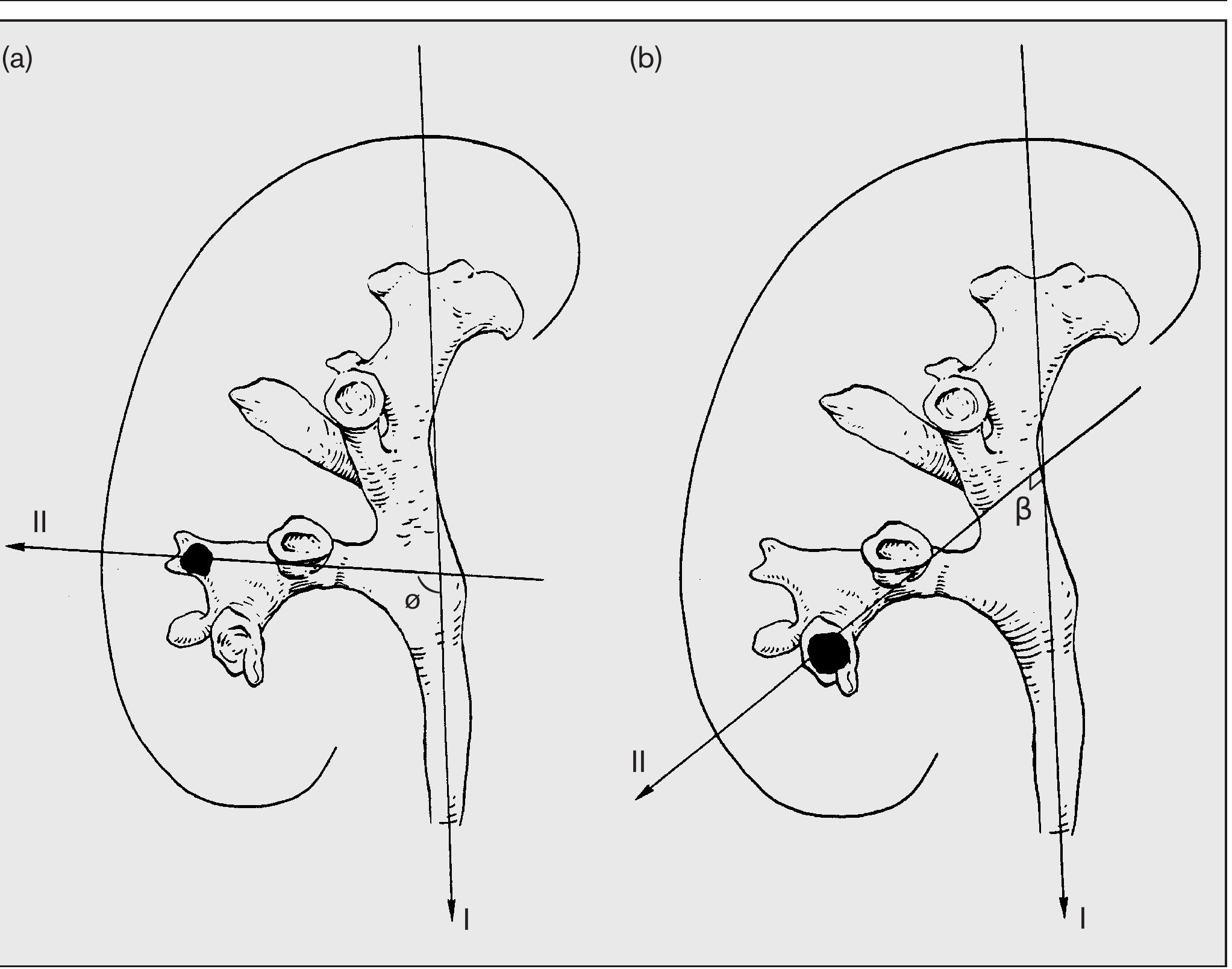 (PDF) Renal collecting system anatomy: its possible role in the ...