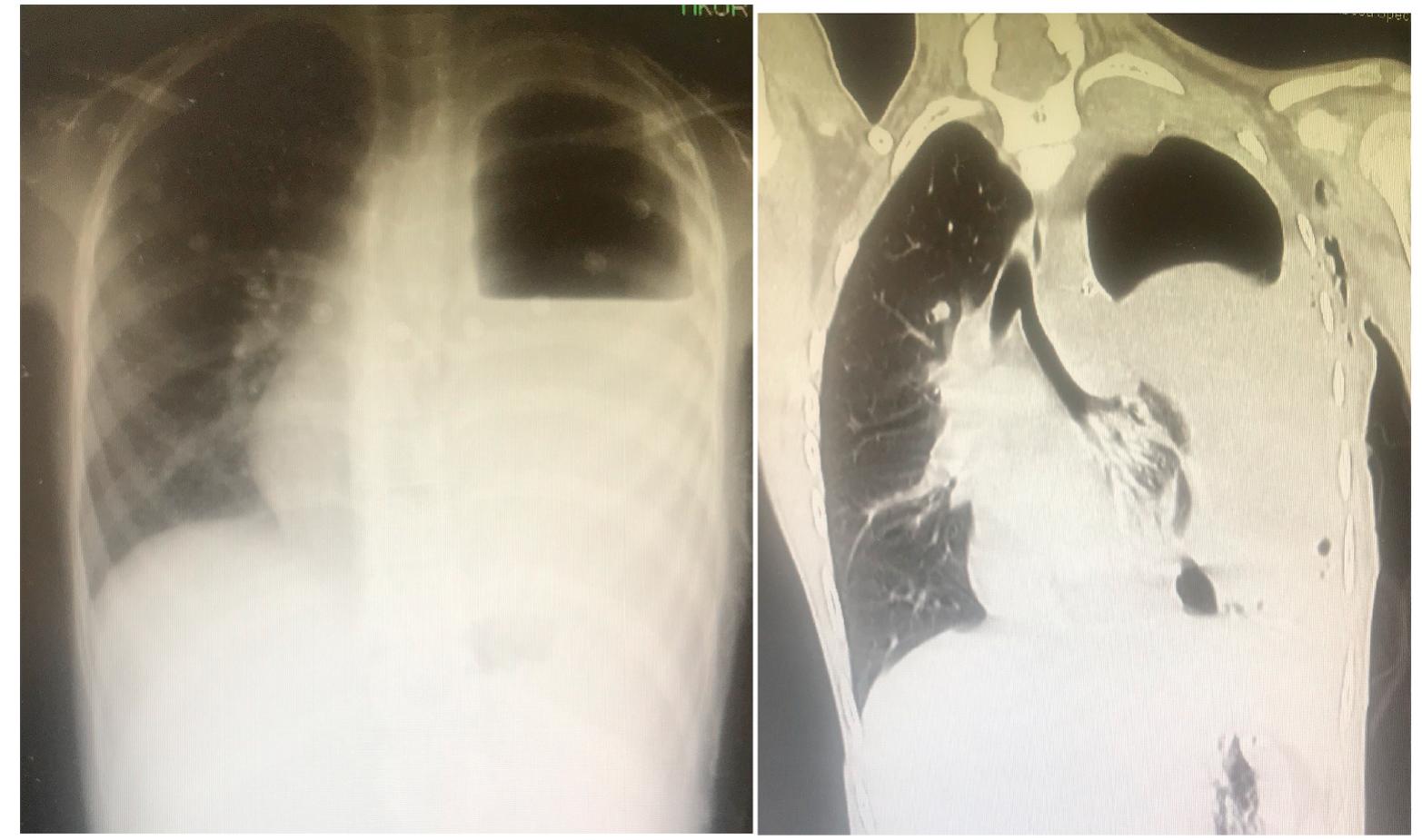 Control chest radiography and ct scan of the chest taken on