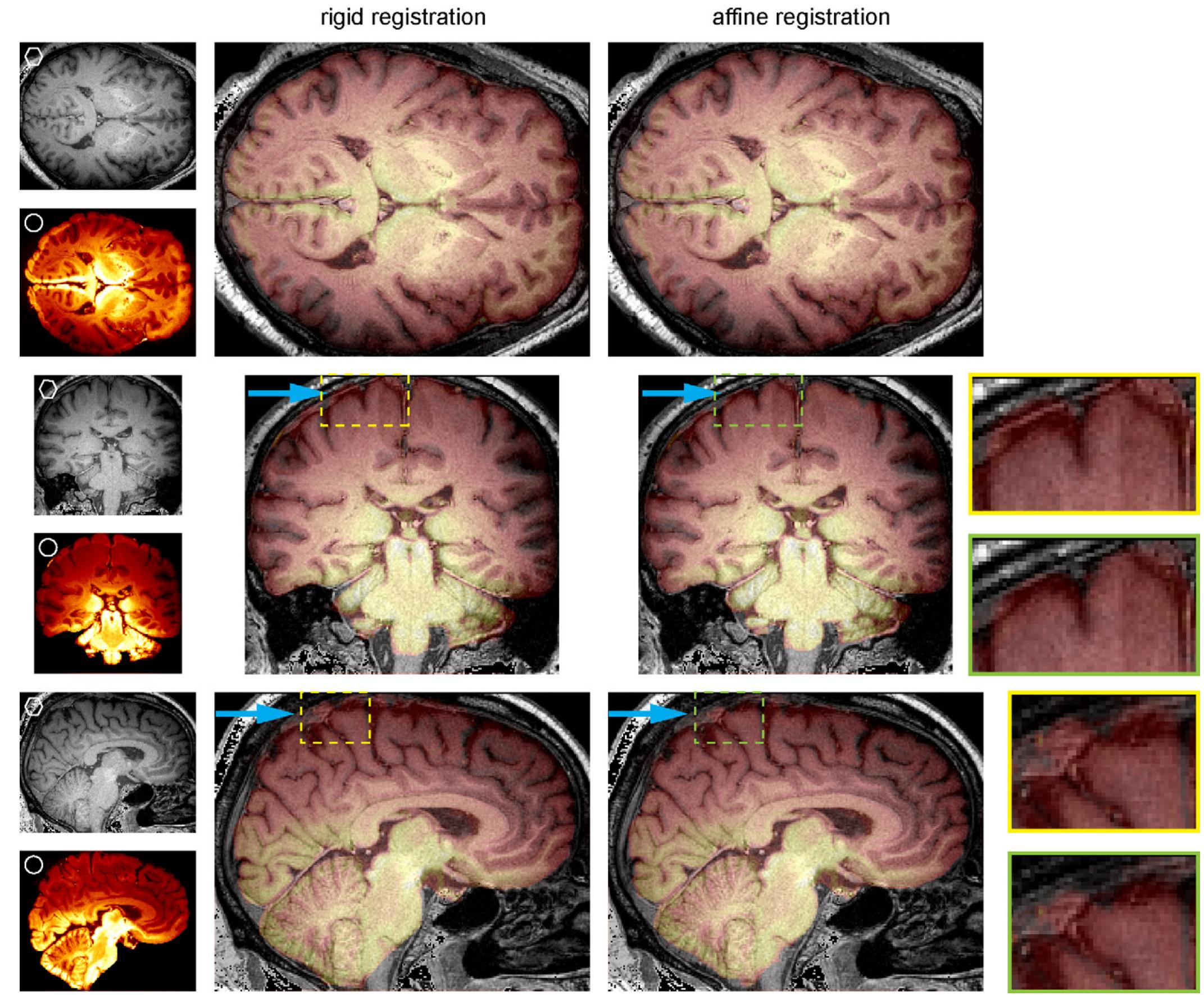 (PDF) Three-dimensional strain fields in human brain resulting from ...