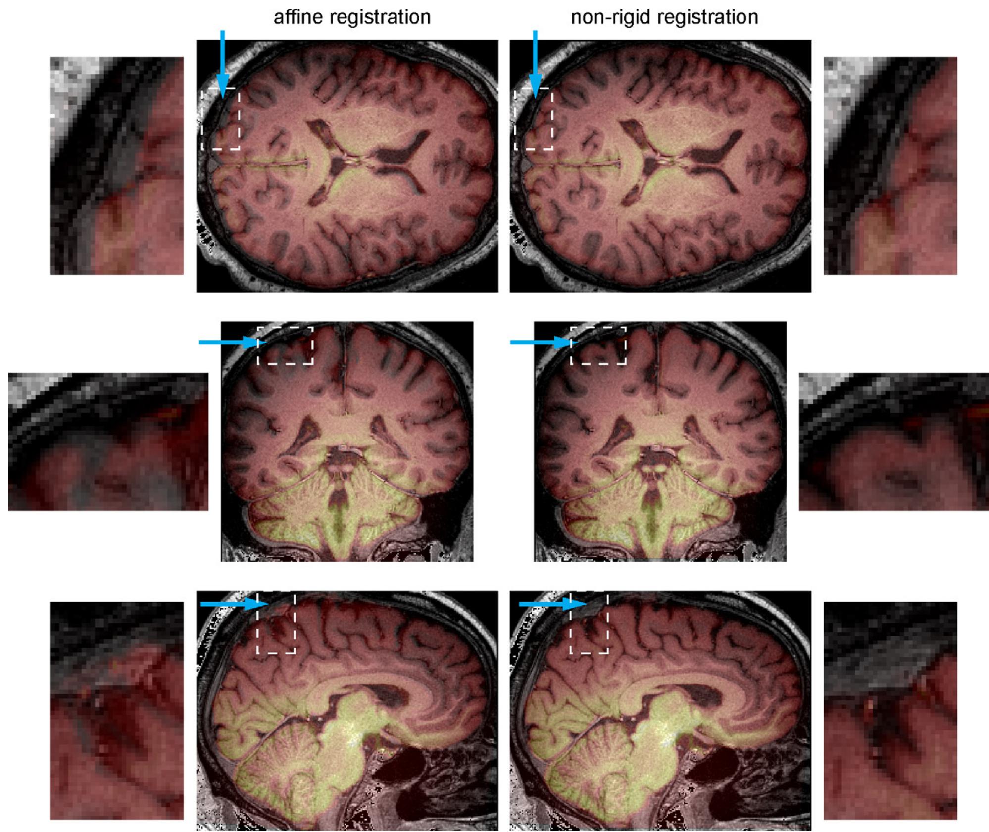 Non Rigid Image Affine Registration Algorithm Python (PDF) Three-dimensional strain fields in human brain resulting from ...