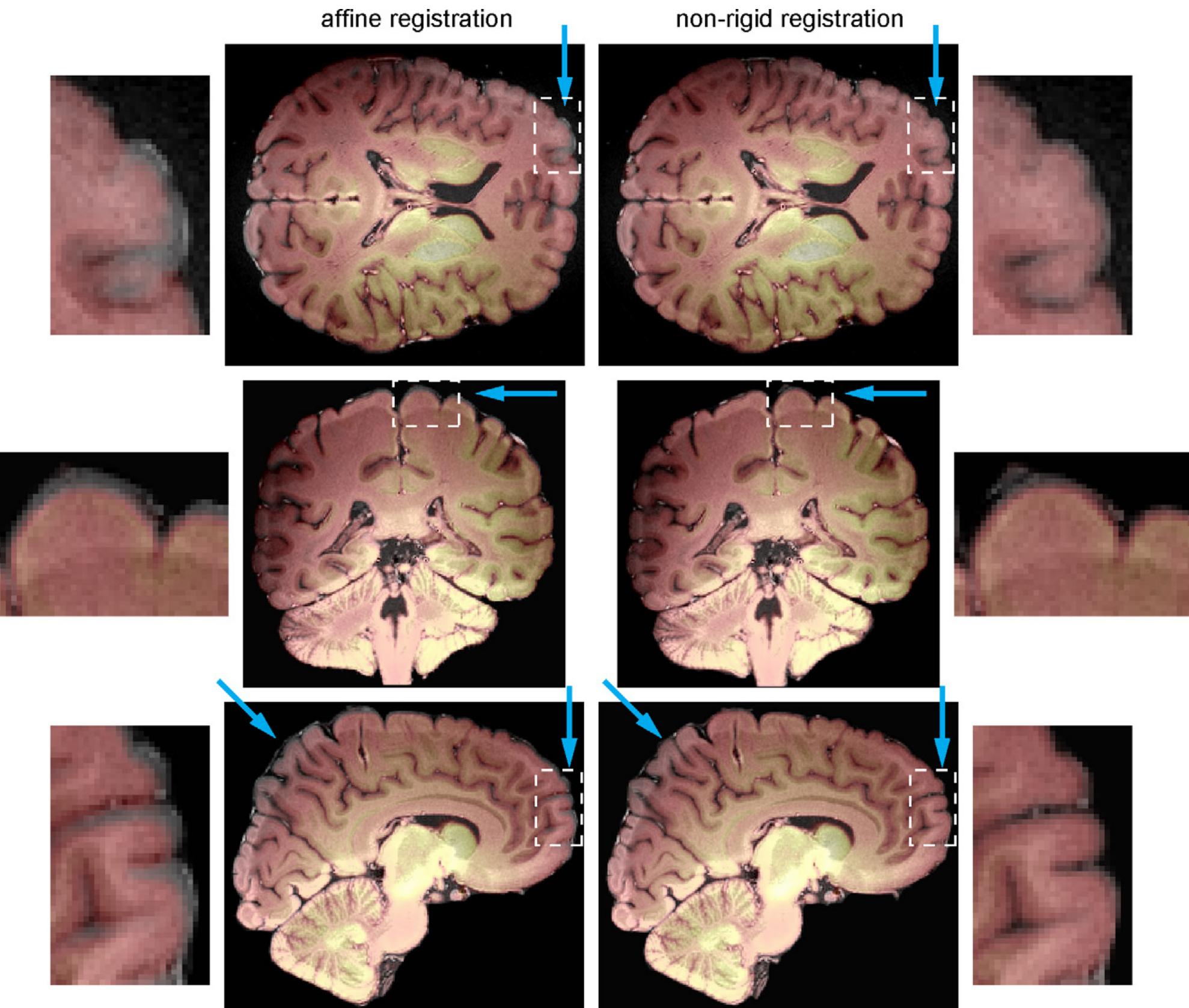 Non Rigid Image Affine Registration Algorithm Python (PDF) Three-dimensional strain fields in human brain resulting from ...