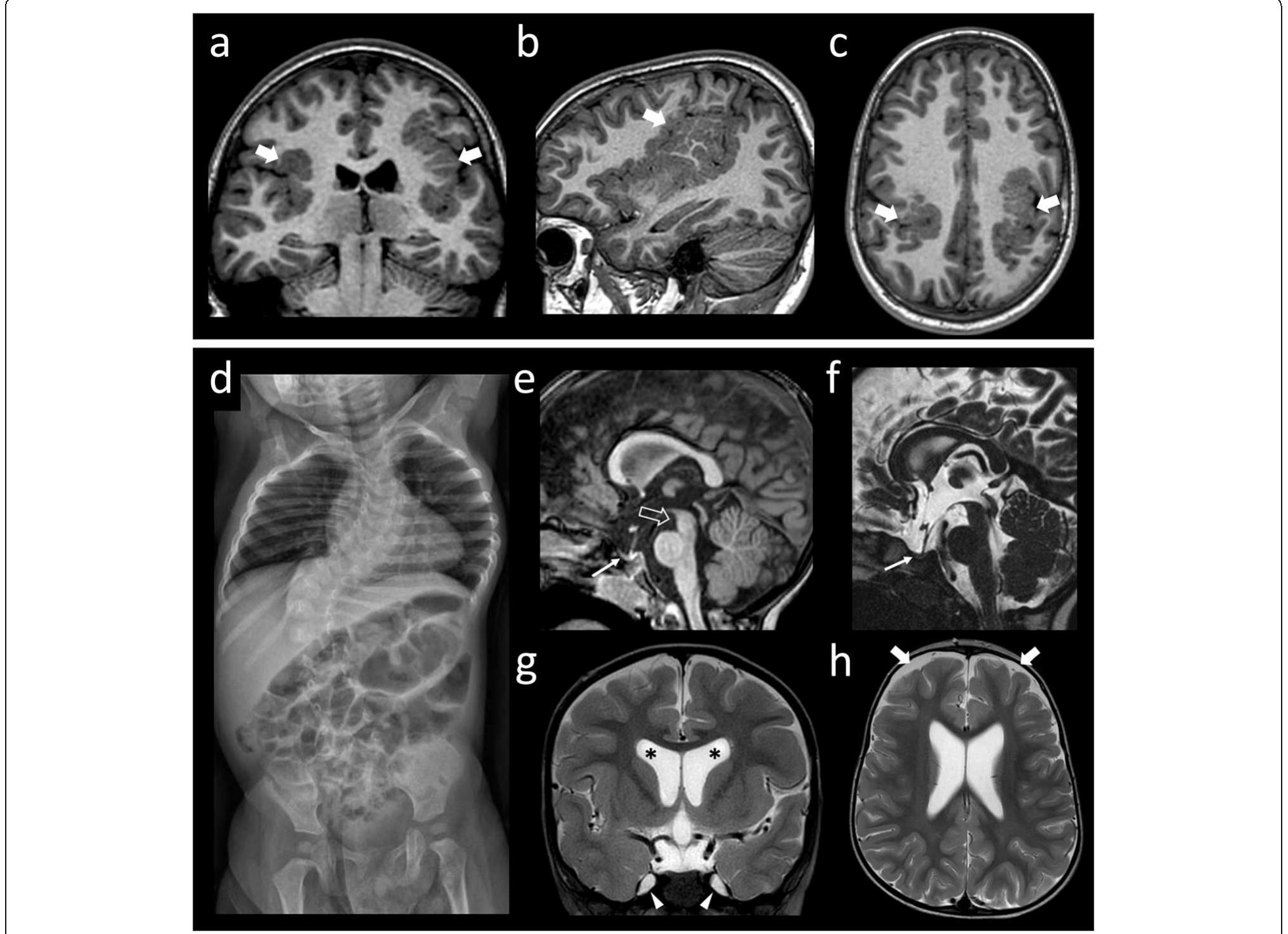 Radiological features. a-c) brain mri of patient 1 performed