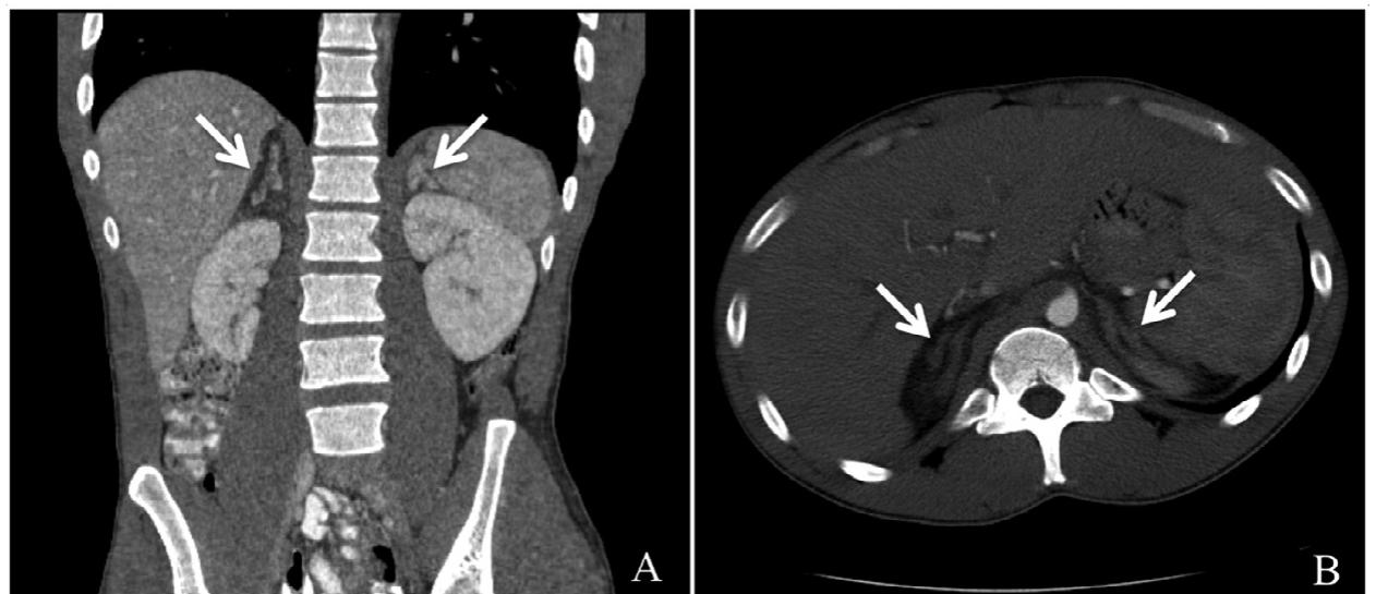 Pseudomass. axial contrast enhanced ct (a) shows a gastric