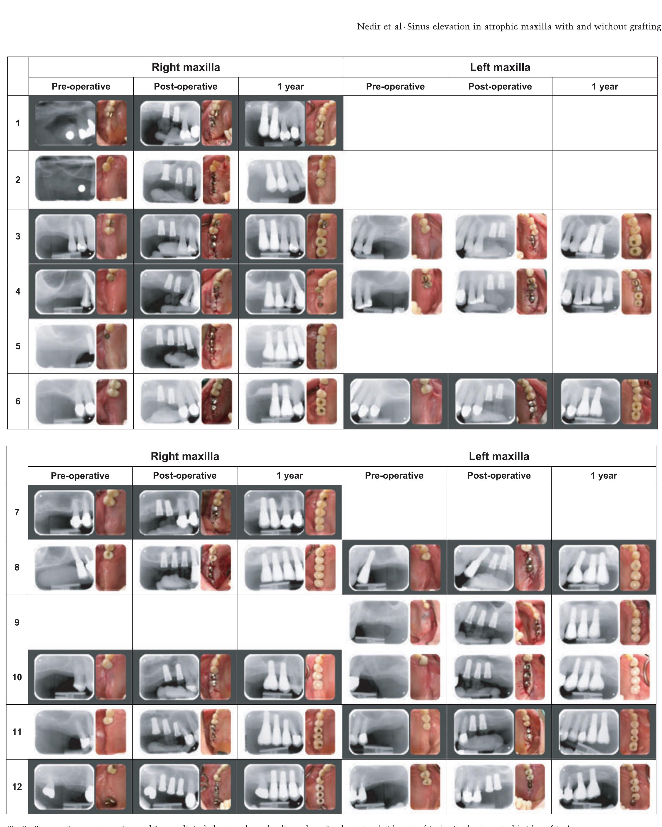 (PDF) Osteotome sinus floor elevation with and without grafting ...