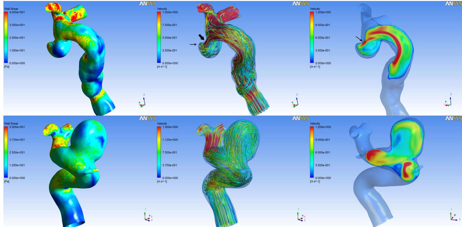 Figure 3 - from Morphologic and hemodynamic analysis of