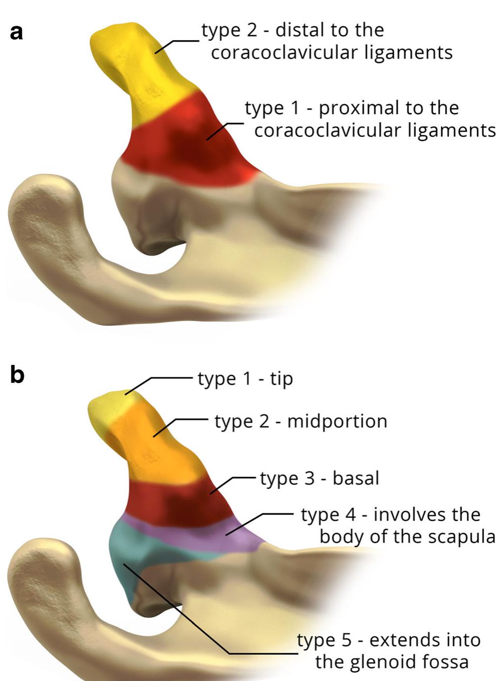 (PDF) Coracoid process fractures: anatomy, injury patterns ...