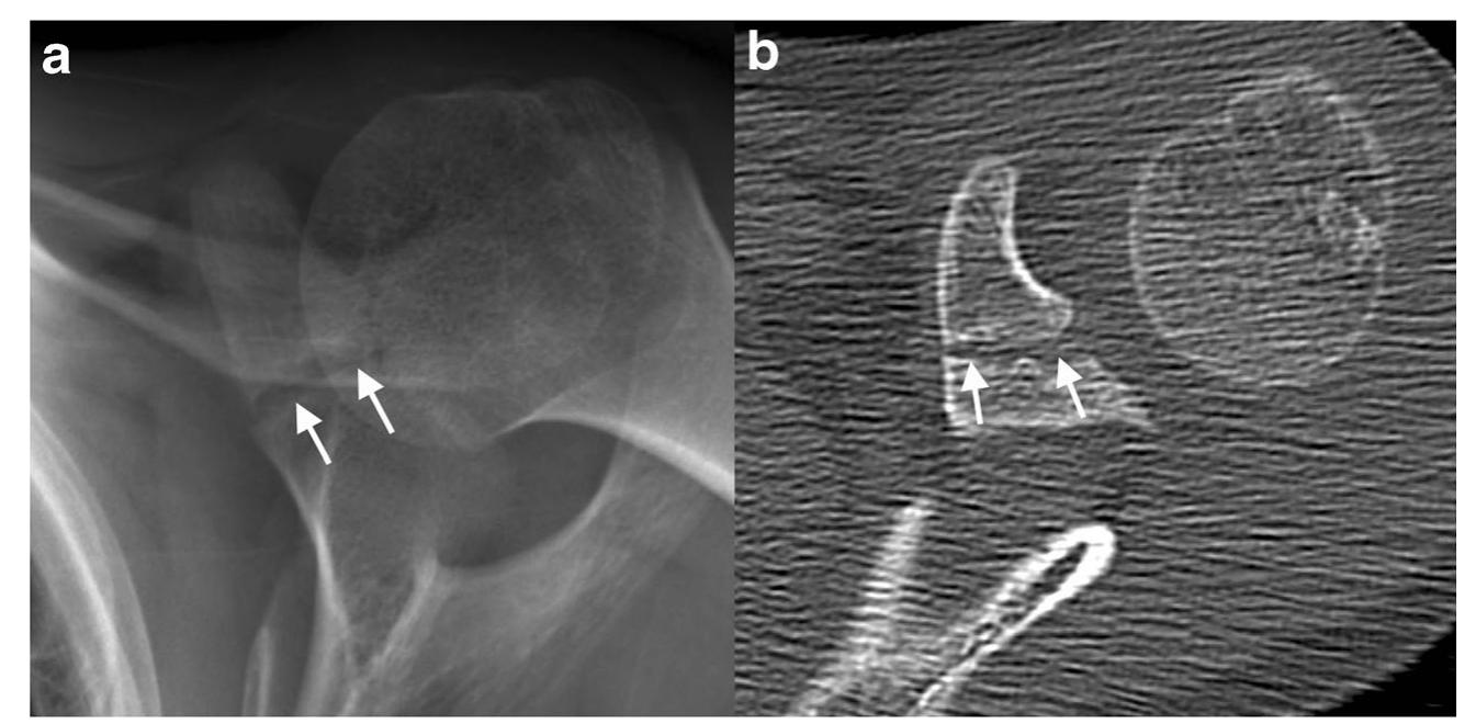 (PDF) Coracoid process fractures: anatomy, injury patterns ...