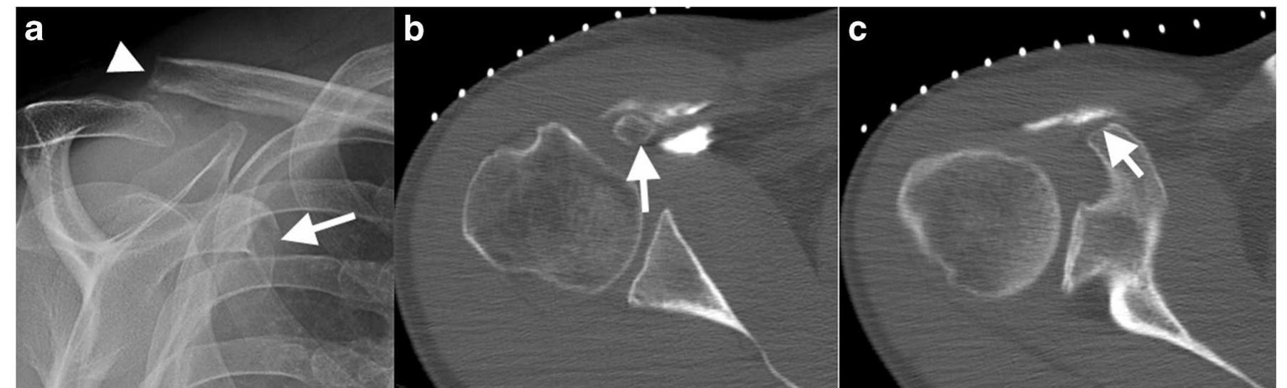 (PDF) Coracoid process fractures: anatomy, injury patterns ...