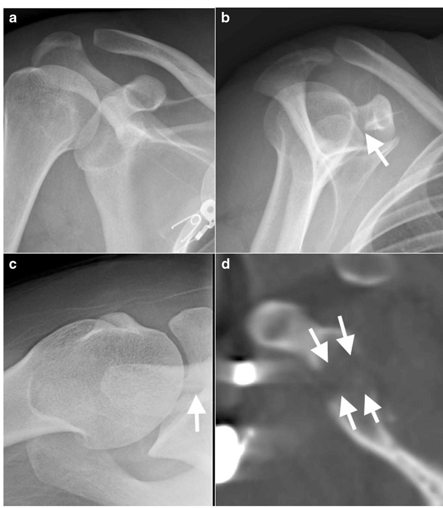 (PDF) Coracoid process fractures: anatomy, injury patterns ...