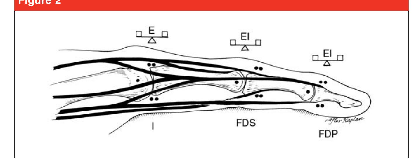 (PDF) Intrinsic Contracture of the Hand: Diagnosis and Management