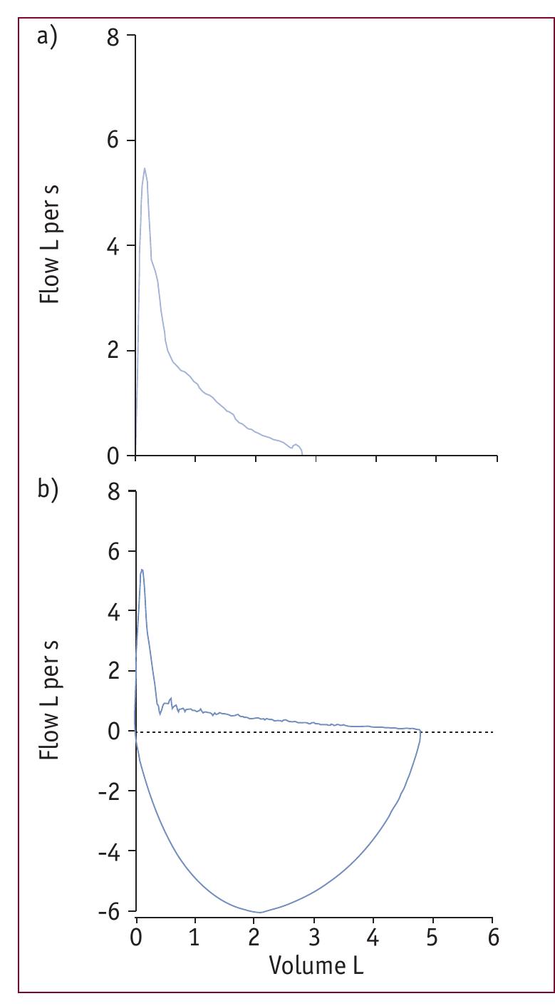 Spirometry Normal Values Pdf (PDF) How to interpret spirometry