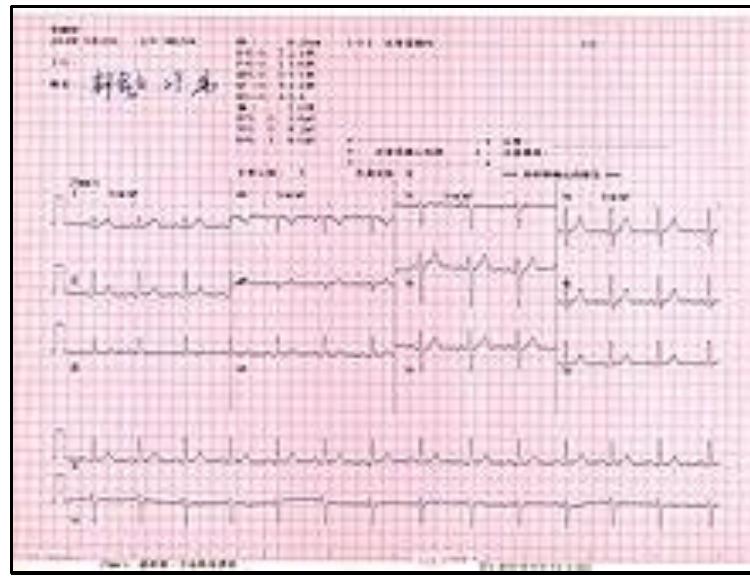 Figure 3 - Micro-ECG-monitoring system based on arduino with