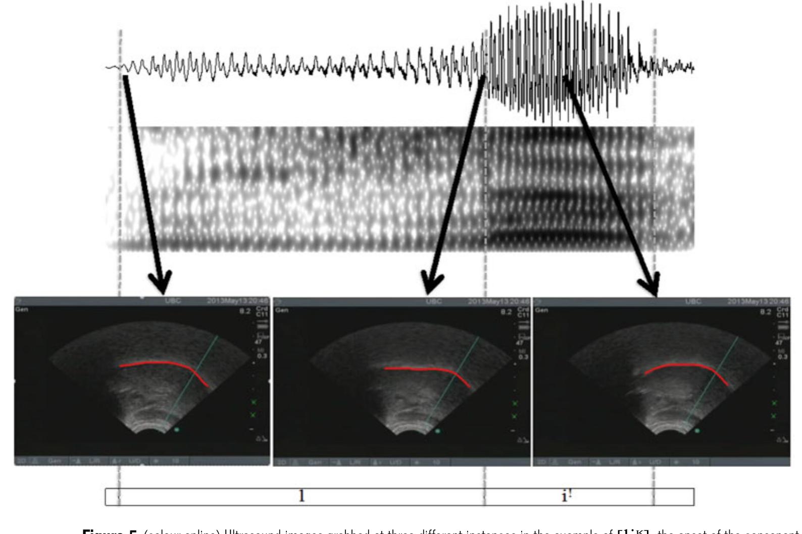 W SIVE UO Lids CQUIVAICIIL, Daell taleel WOO Wds LOpedled UNE UTES DY UO COMSUILATIL, The ultrasound images were recorded as video clips by the third author. Simultaneously, participants’ acoustic production was recorded concurrently with ultrasound images. Syllable boundaries and segments of the consonants and vowels were first labeled using Praat, and then loaded and aligned with videos using ELAN. Based on inspection of the audio and video files, images at three time points were grabbed from the videos: (i) the onset of the initial consonant, (ii) the onset of the vowel, and (iii) the center of the vowel (see Figure 5). Grabbed images were imported to EdgeTrak (Li, Kambhamettu & Stone 2005) for tongue 