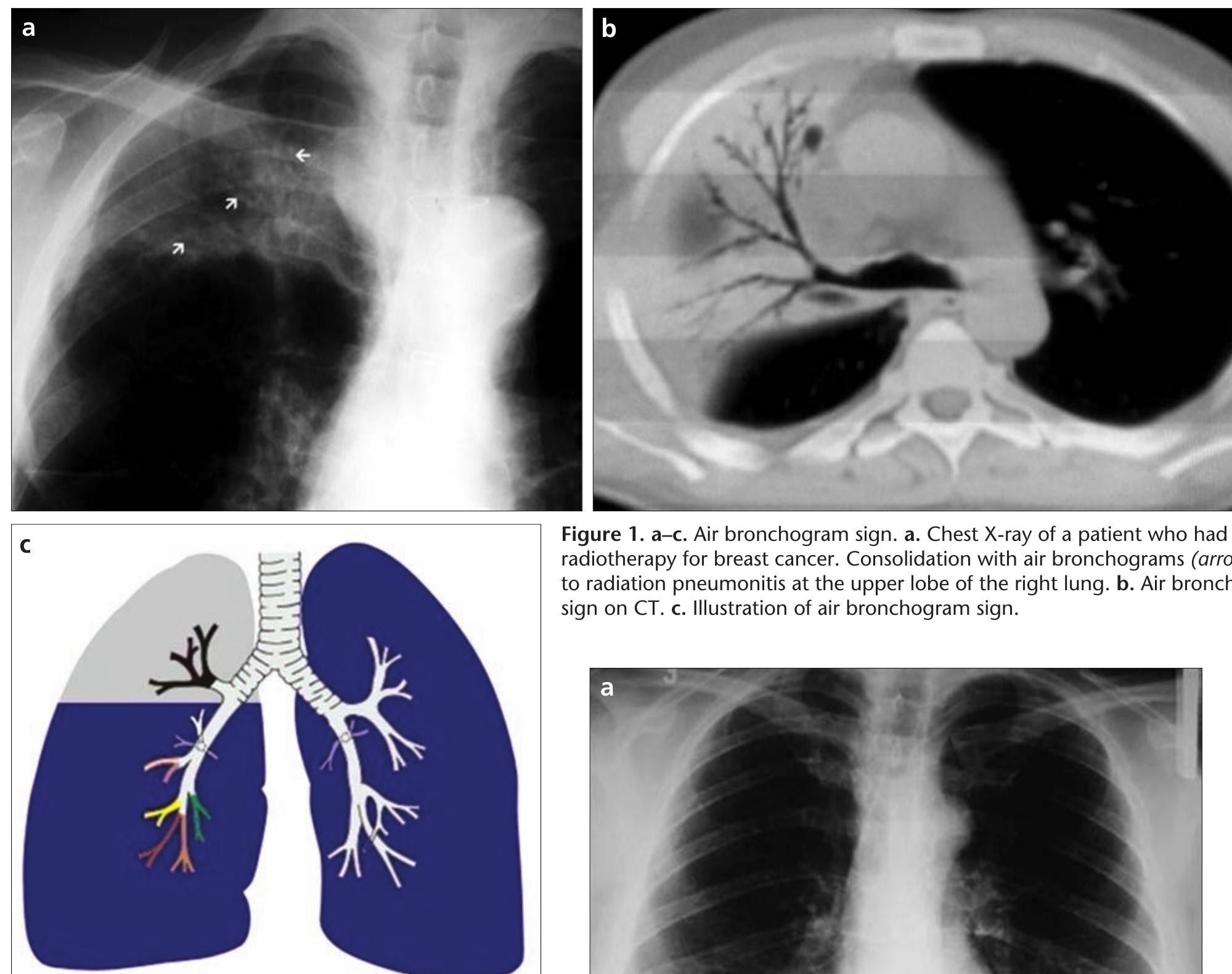 Figure 1 - Signs in chest imaging: a pictorial review