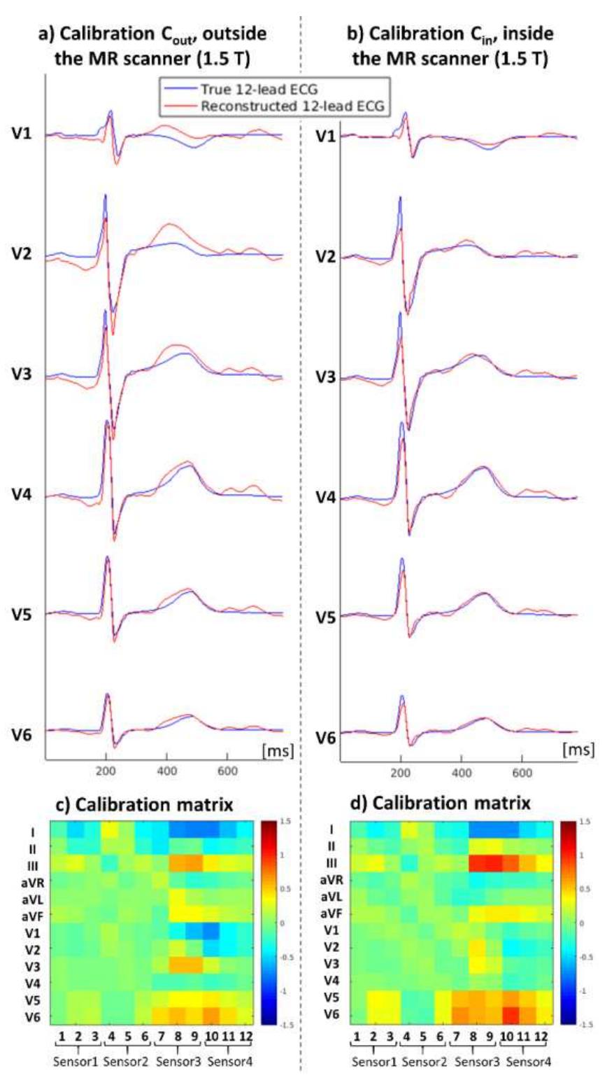 Figure 5 - Reconstruction of the 12‐lead ECG using a novel