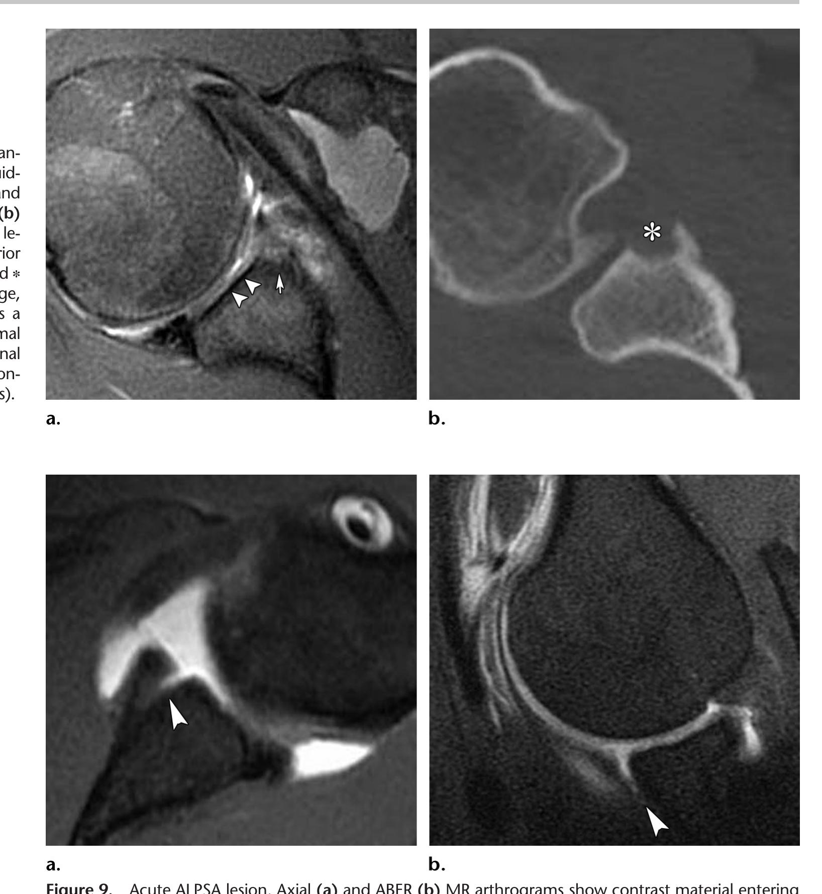 (PDF) Imaging the Glenoid Labrum and Labral Tears
