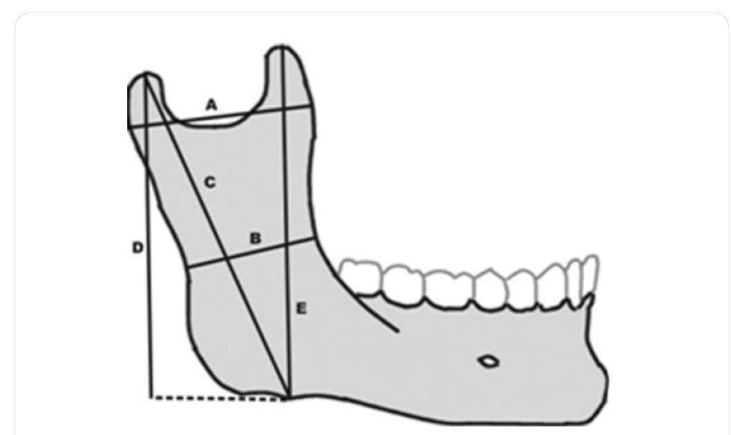 (PDF) Mandibular Indices for Gender Prediction : A Retrospective ...