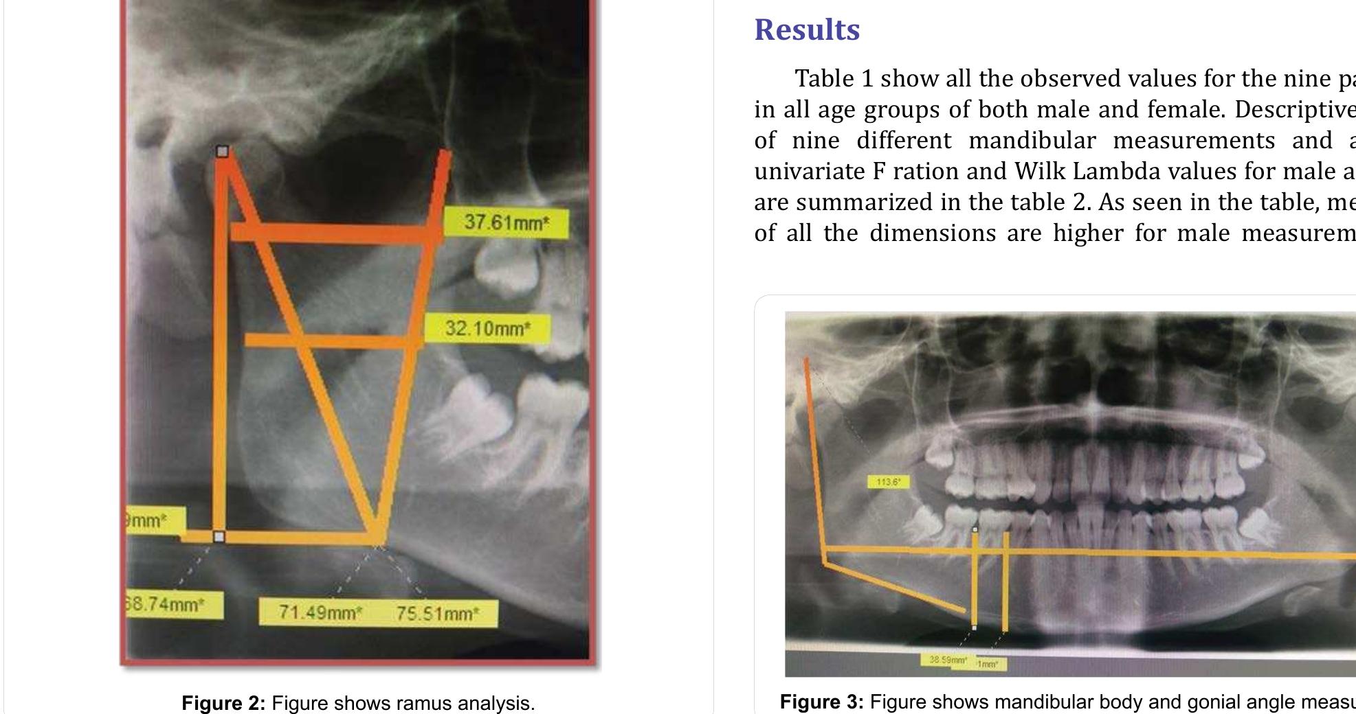 (PDF) Mandibular Indices for Gender Prediction : A Retrospective ...