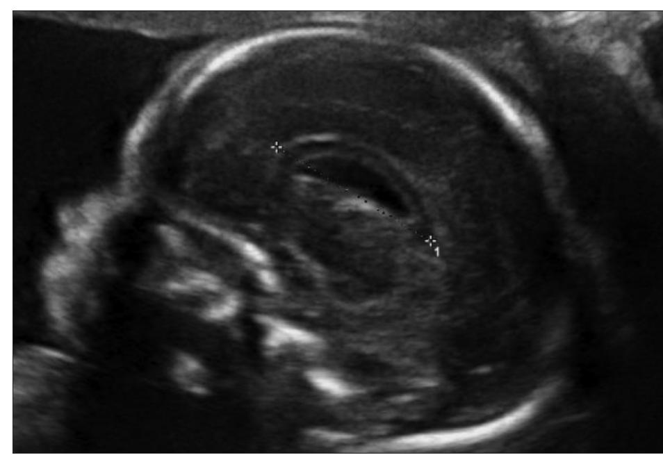 Vari Cox Table 1 - from Reference Charts for Fetal Corpus Callosum