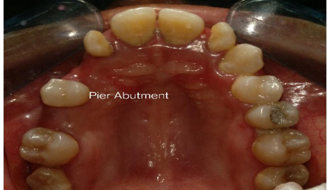(PDF) Pier abutment: Bridge the gap with non rigid connector - A ...
