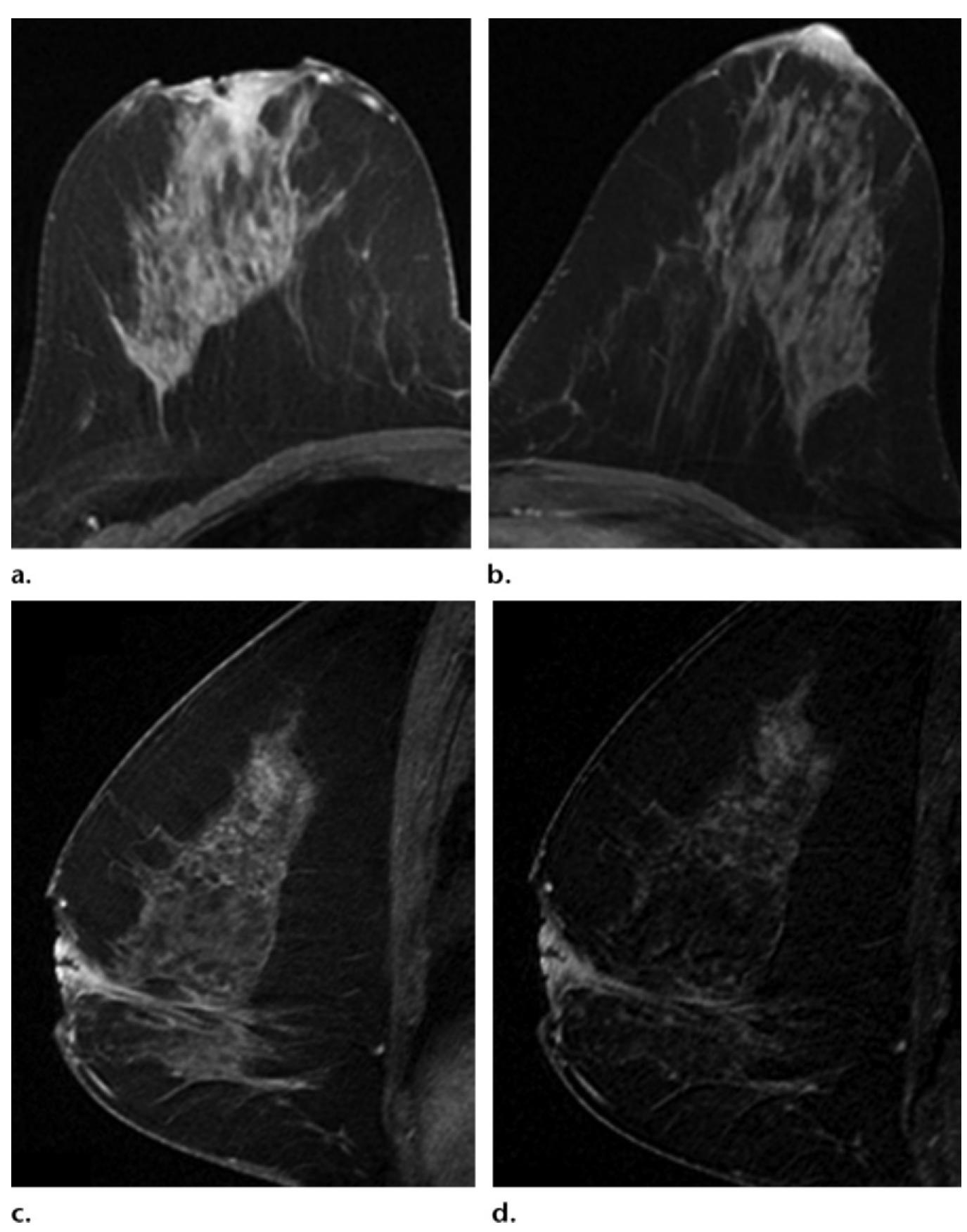 (PDF) Imaging Approaches to Diagnosis and Management of Common Ductal ...