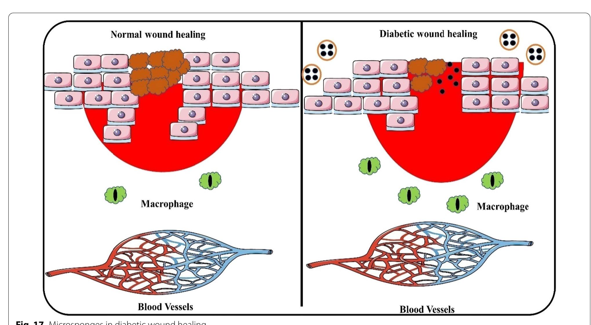 Microsponge drug mechanism in skin infections down. because