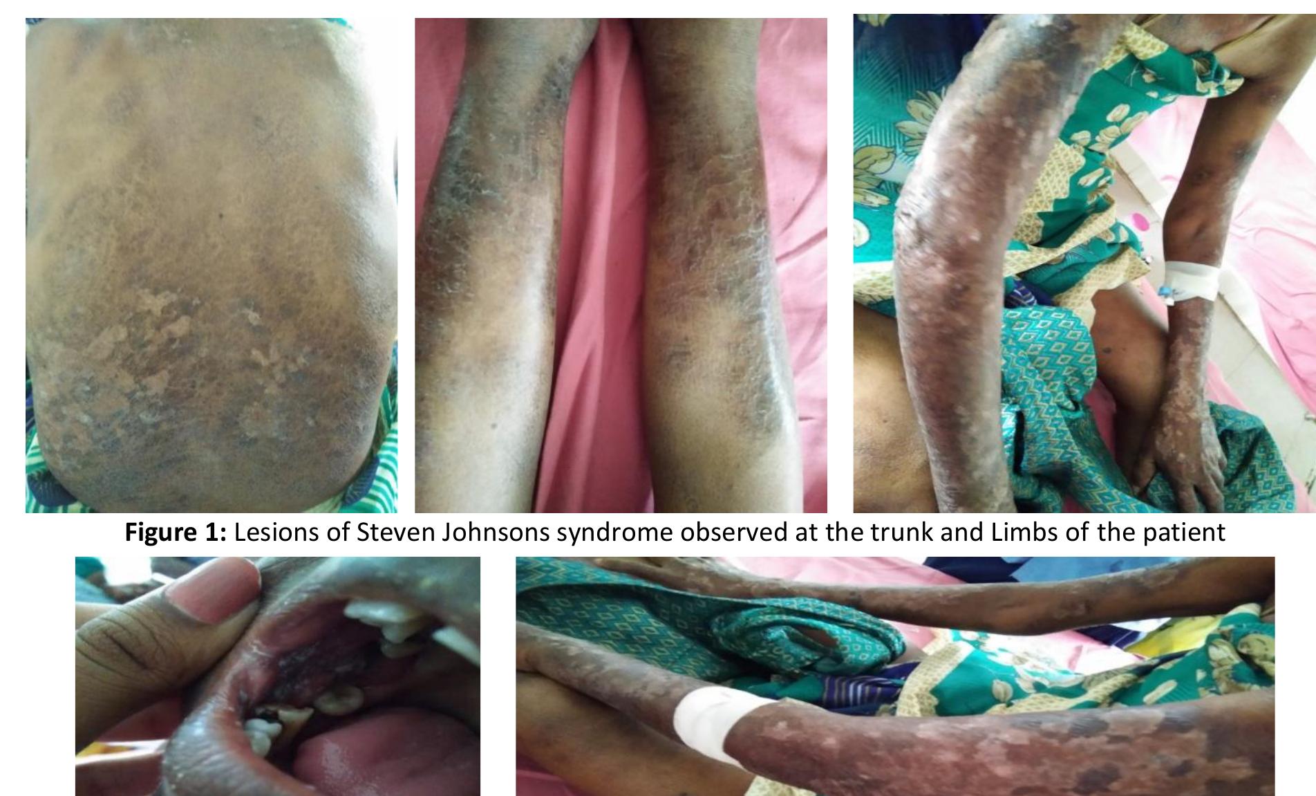 Entry Rashed (PDF) Ceftriaxone Induced Steven Johnson Syndrome: A Case Report