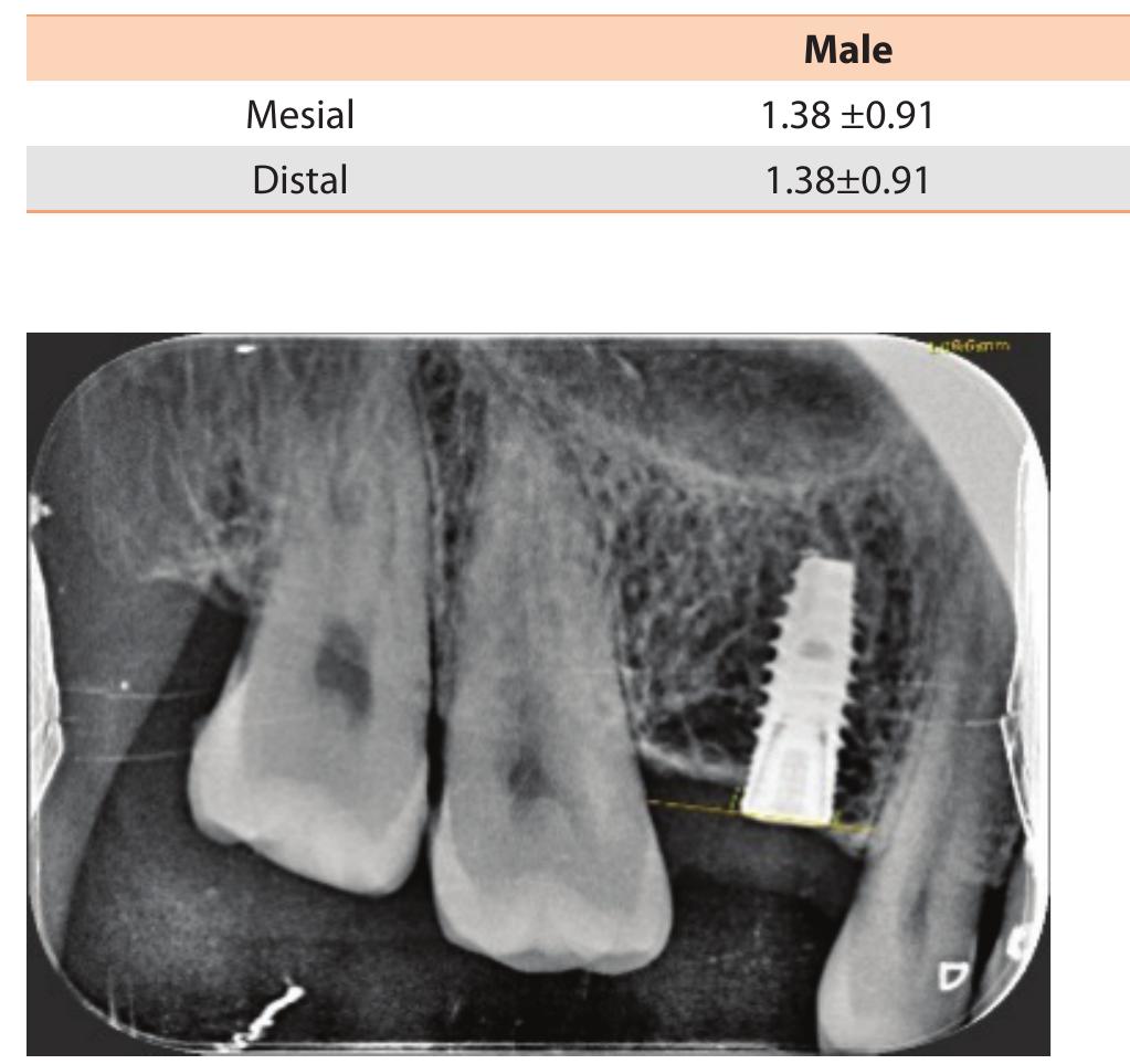 (PDF) Evaluation of marginal bone level after implant placement and ...