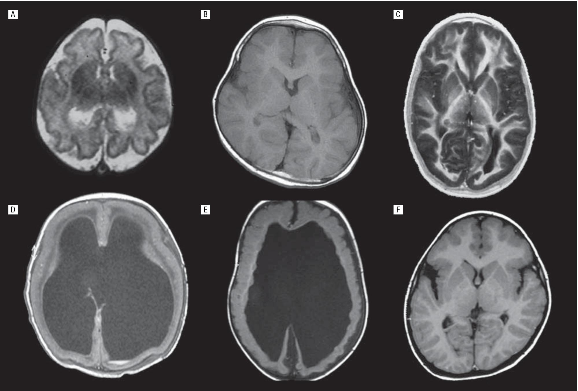 (PDF) Cortical Brain Malformations