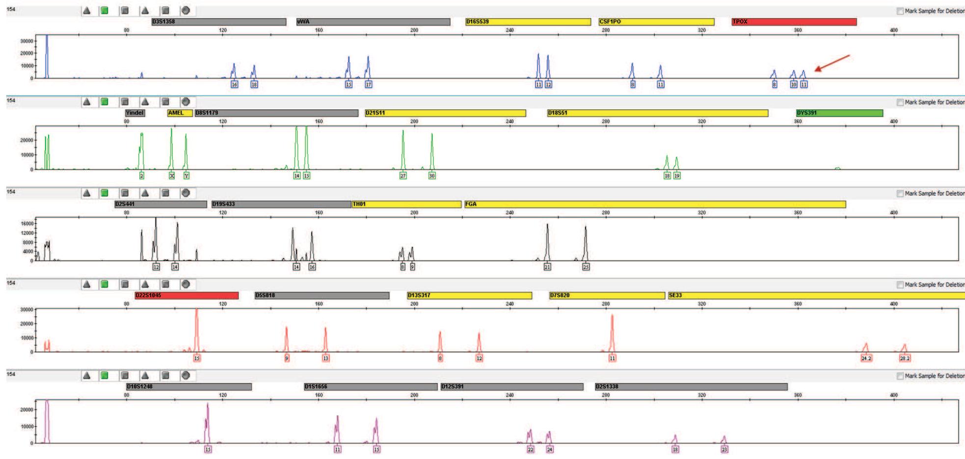 Figure 2- Tri-allelic variants in TPOX locus observed in sample #154.  software [20] for all populations in corrected fixation index (Fst) for phylogeny with 1000 permutations [22].  The average allele number per marker was 12, 