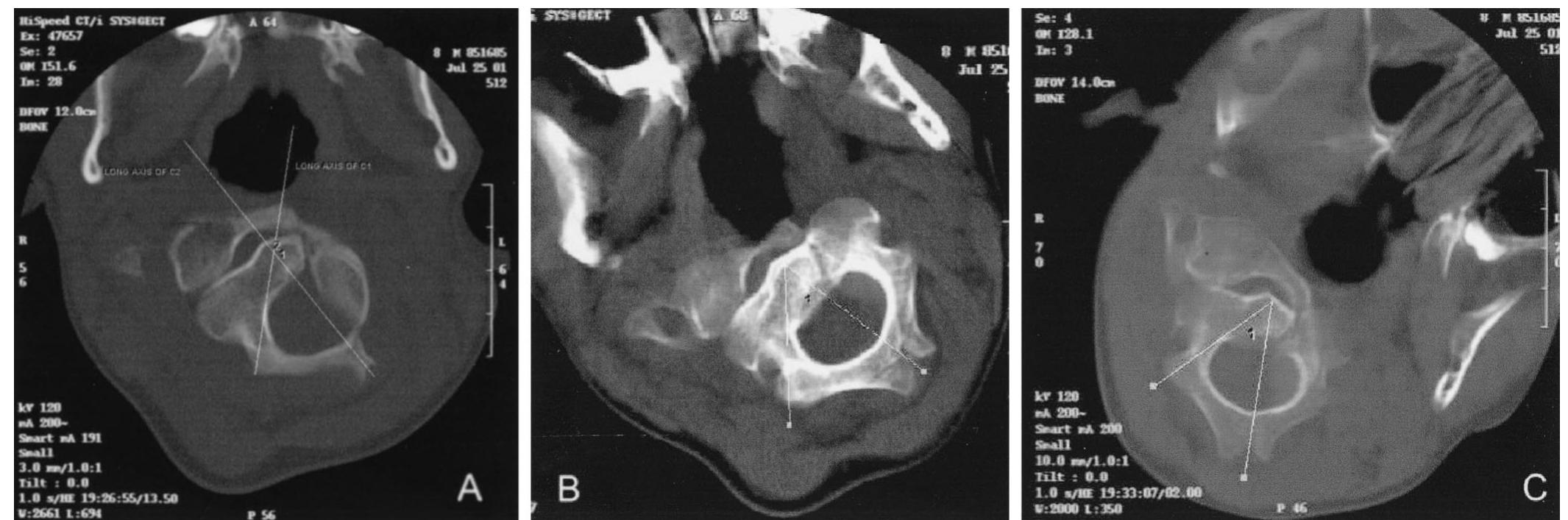 (PDF) Chronic Atlantoaxial Rotatory Fixation with Anterolisthesis: Case ...