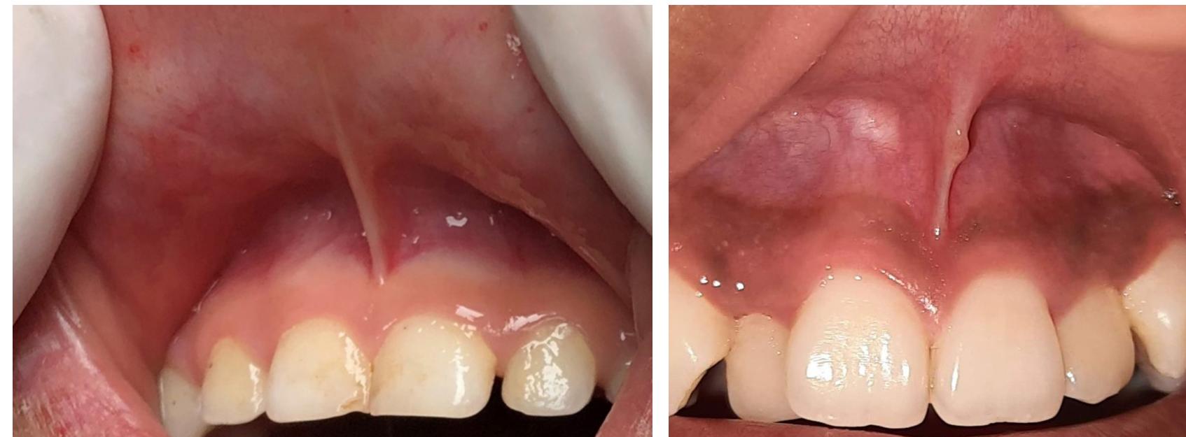 Figure 2 - from Variations in Maxillary Frenal Morphology in