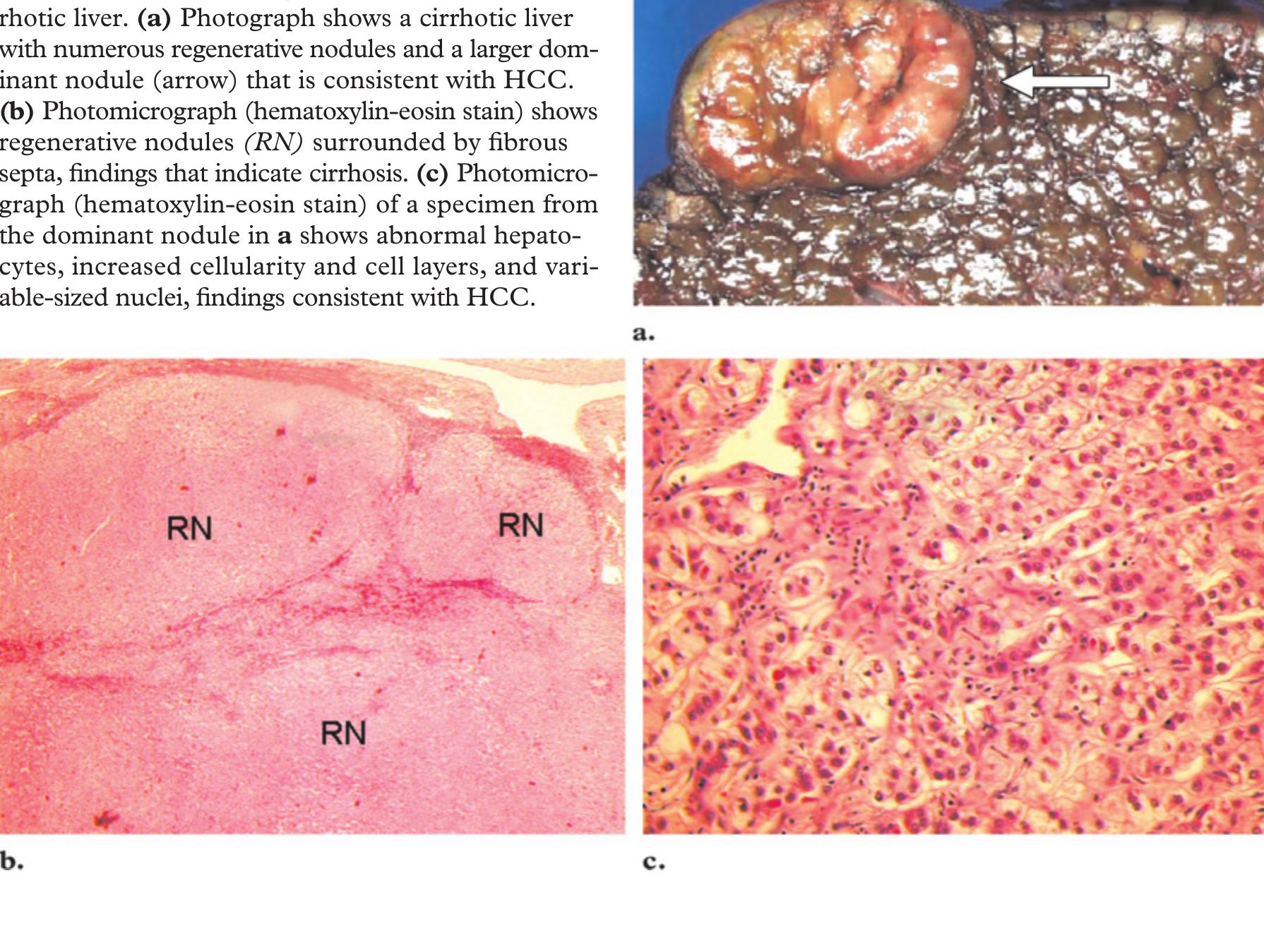 Figure 10 - from Cirrhosis and Lesion Characterization at MR